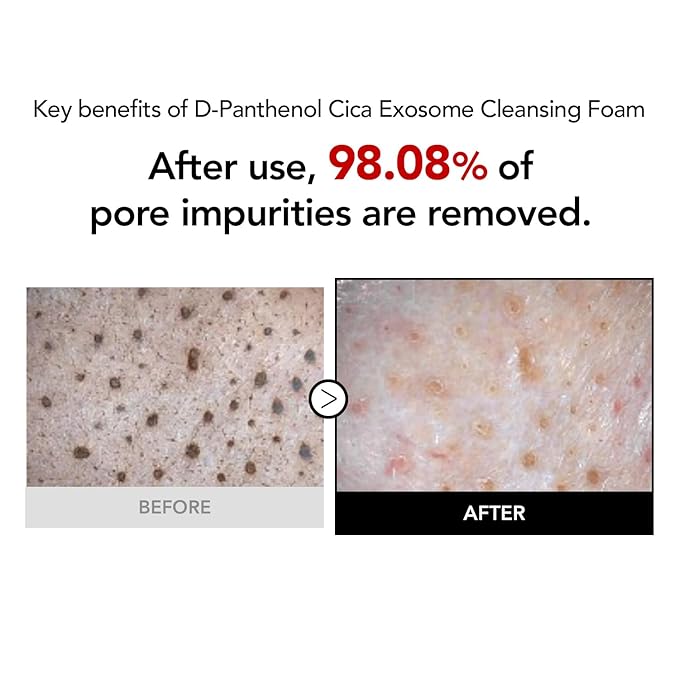 98% Reduction in Pore Impurities & 92% Less Sebum – Improves Blackheads & Whiteheads by 36% – Soothes & Strengthens Skin Barrier with D-Panthenol – Korean Skincare Best Cleansing Foam