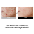 98% Reduction in Pore Impurities & 92% Less Sebum – Improves Blackheads & Whiteheads by 36% – Soothes & Strengthens Skin Barrier with D-Panthenol – Korean Skincare Best Cleansing Foam