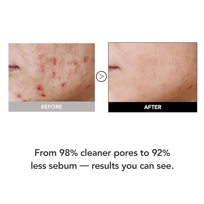 98% Reduction in Pore Impurities & 92% Less Sebum – Improves Blackheads & Whiteheads by 36% – Soothes & Strengthens Skin Barrier with D-Panthenol – Korean Skincare Best Cleansing Foam