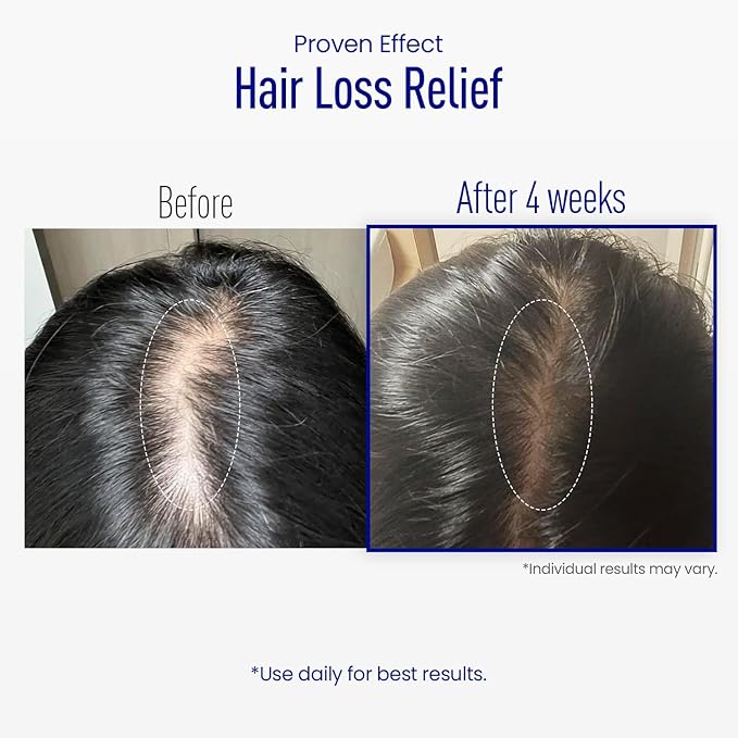 Scalp Microneedle Serum – K-beauty Hair Growth & Scalp Treatment with Spioxyl™ 400 | Fills Hair Part Line, Strengthens Roots, Reduces Hair Thinning – 220,000 Microneedle Formula