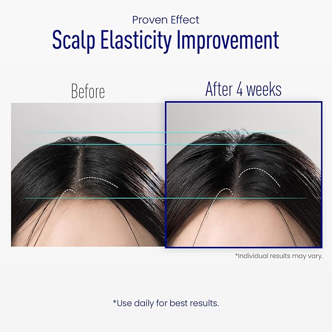 Scalp Microneedle Serum – K-beauty Hair Growth & Scalp Treatment with Spioxyl™ 400 | Fills Hair Part Line, Strengthens Roots, Reduces Hair Thinning – 220,000 Microneedle Formula